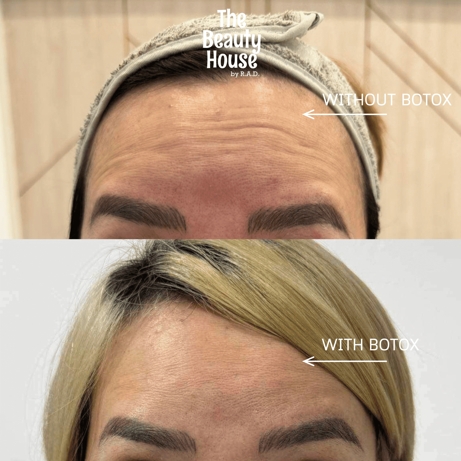 Upperhead Botox
