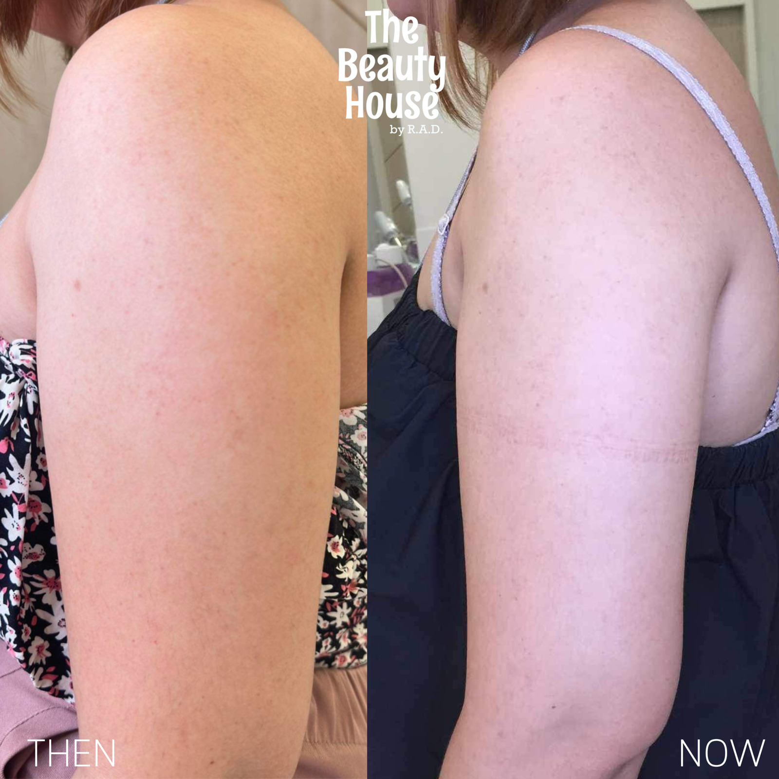 Arms Botox