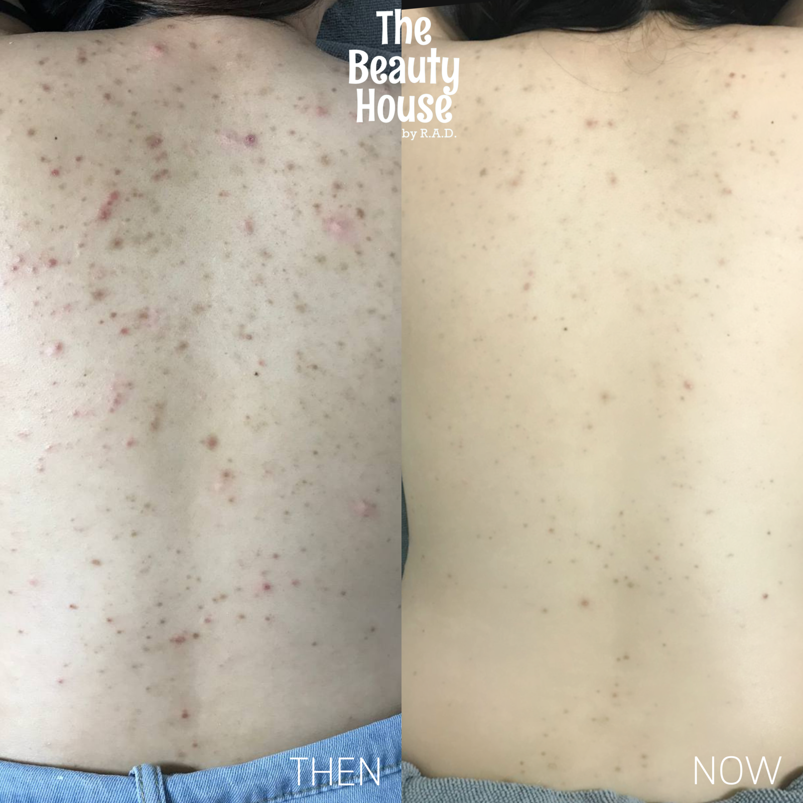 Back Acne Treatment