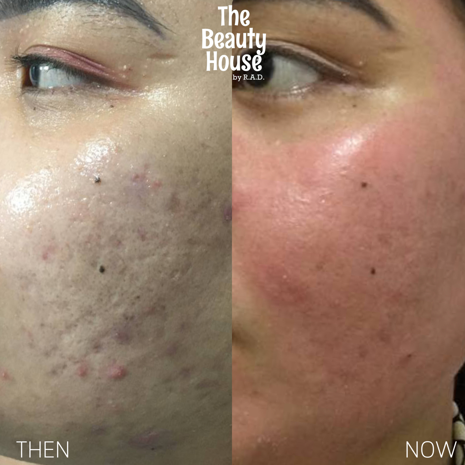 CO2 Fractional Laser