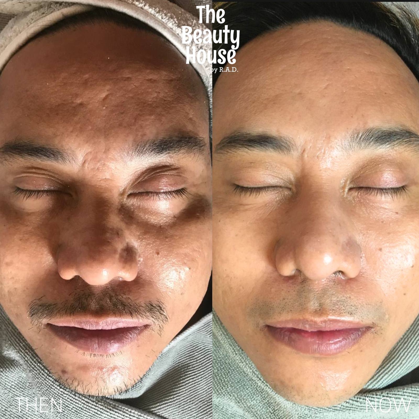 Carbon Peel Laser