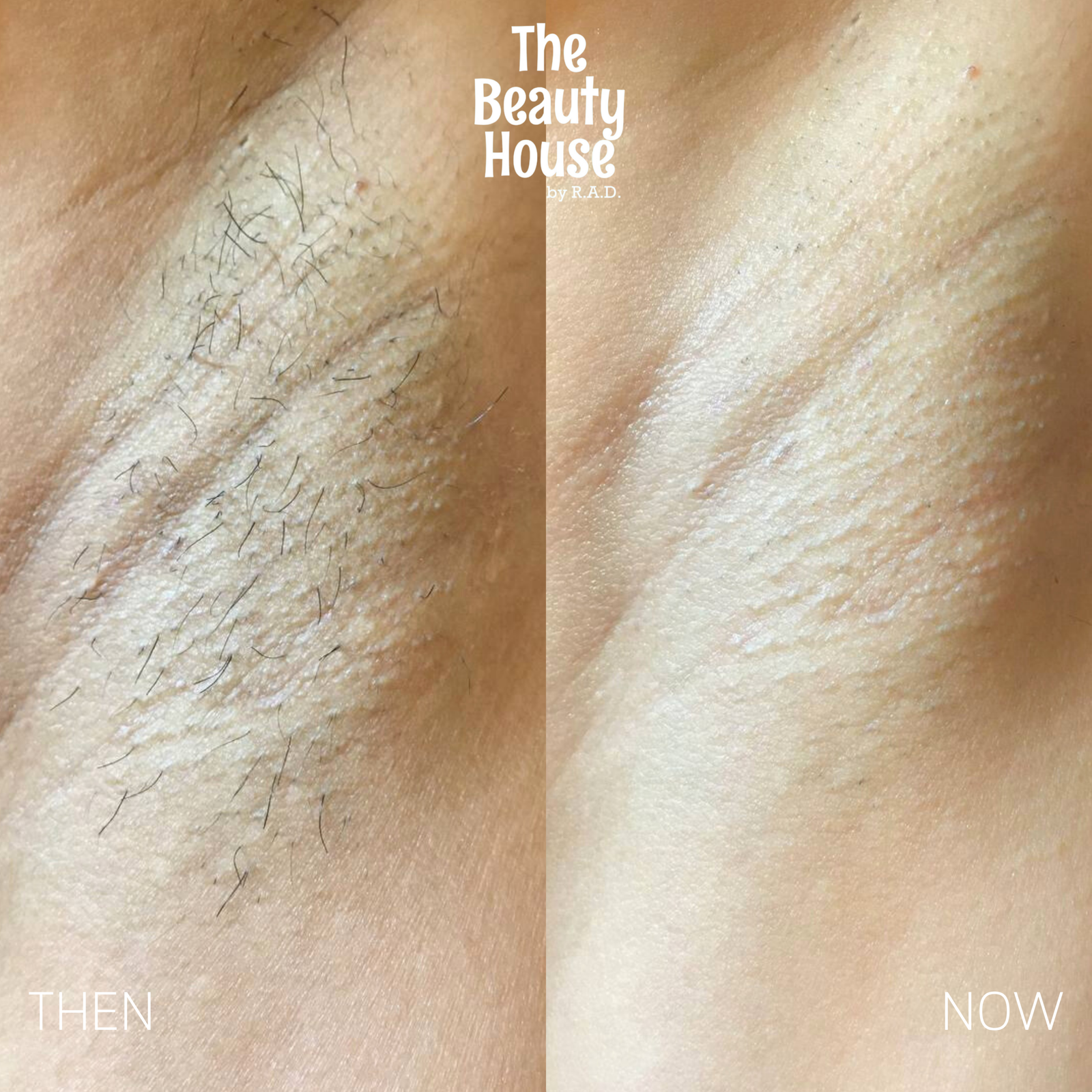 Diode Laser Hair Removal