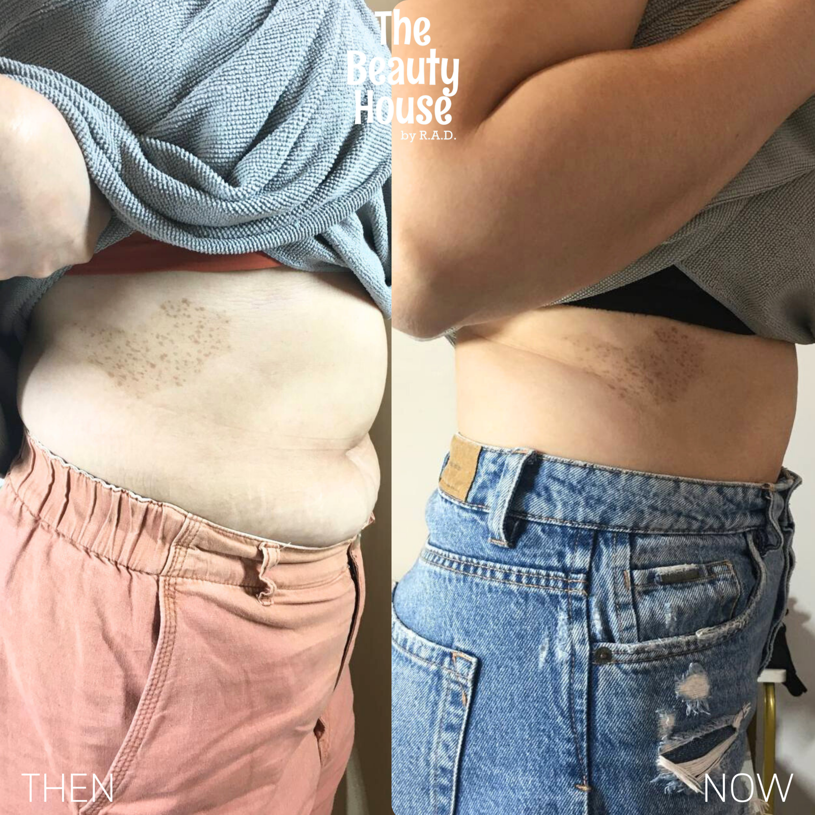 HiFEM Sculpt (Tummy)