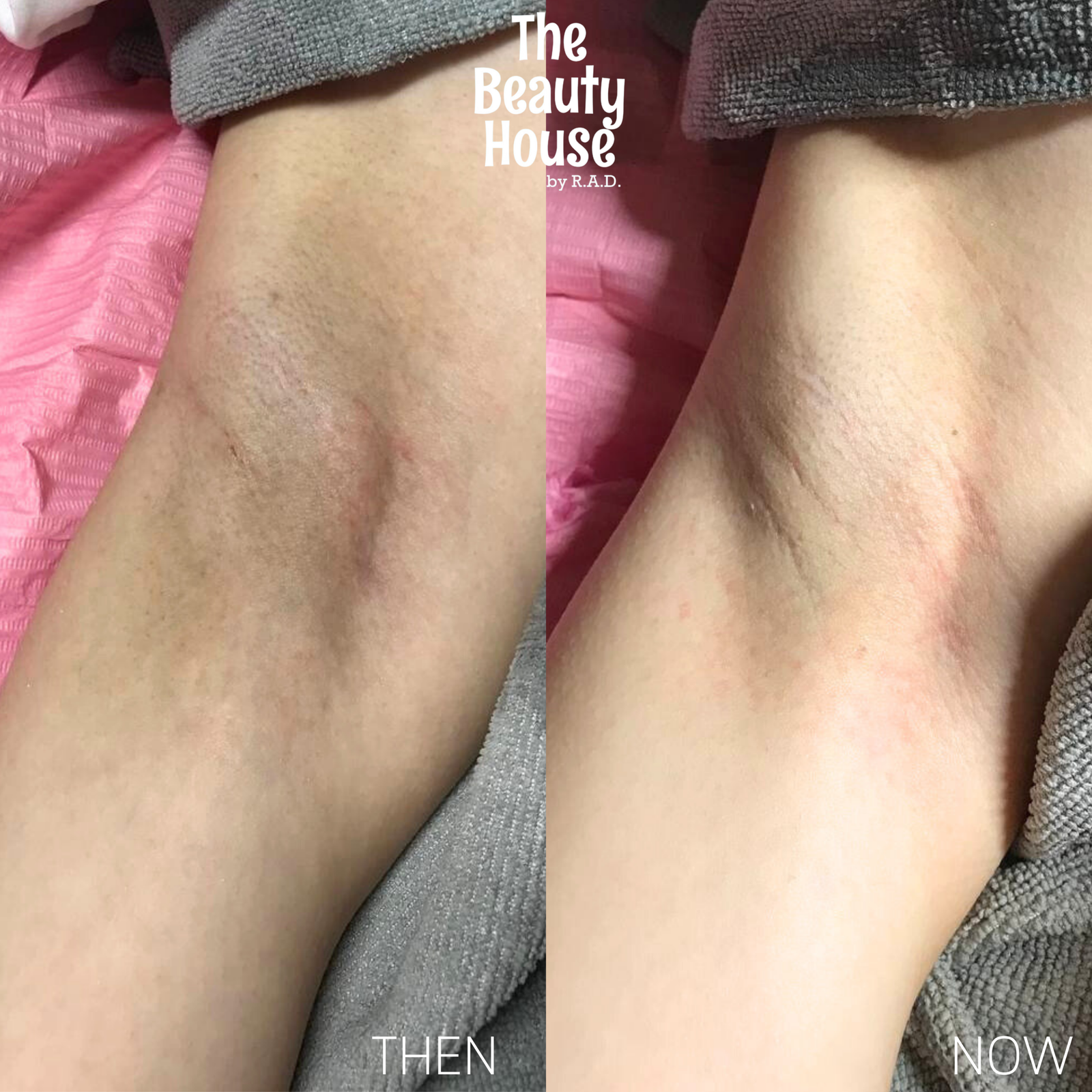 Intensive Whitening Peel