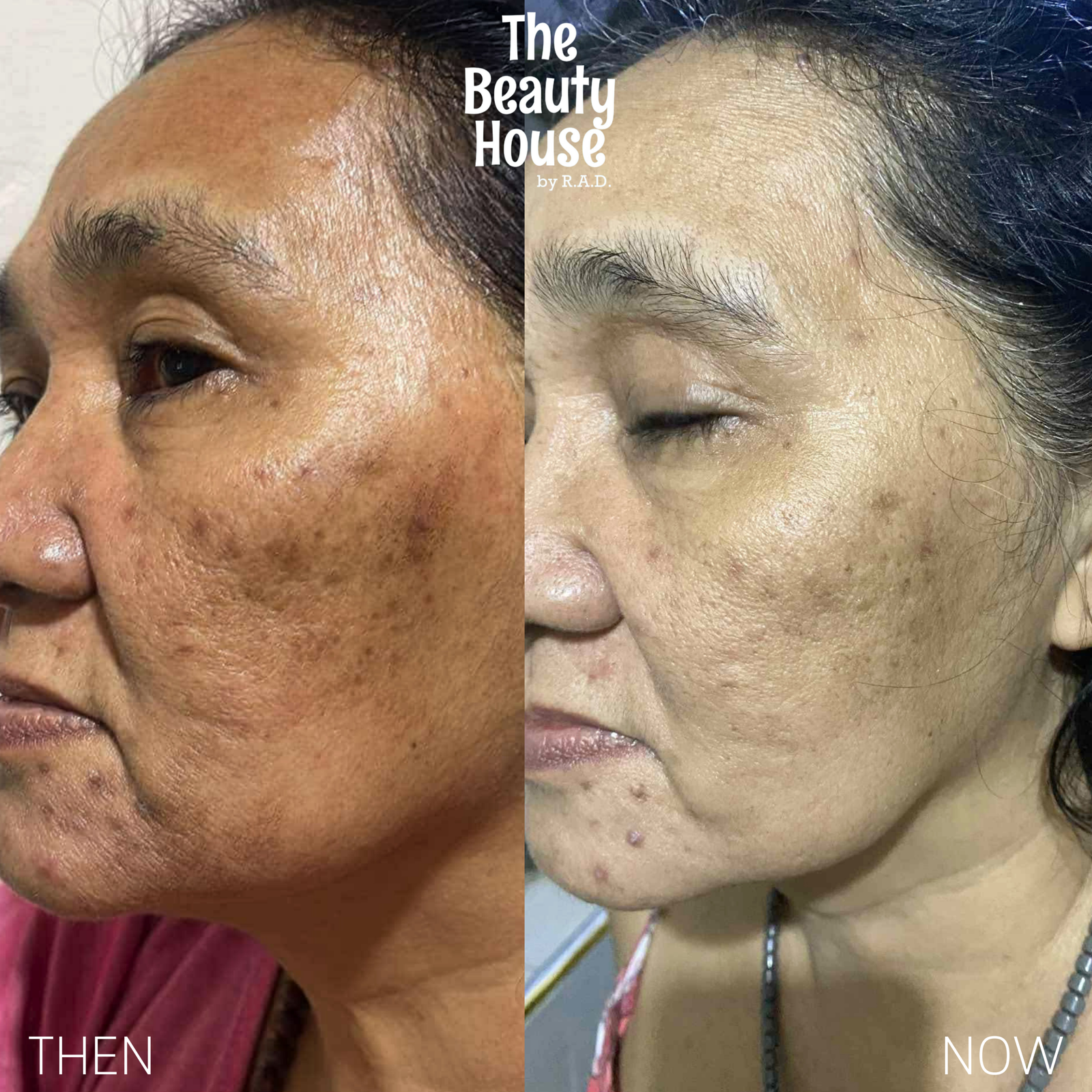 Melasma Removal