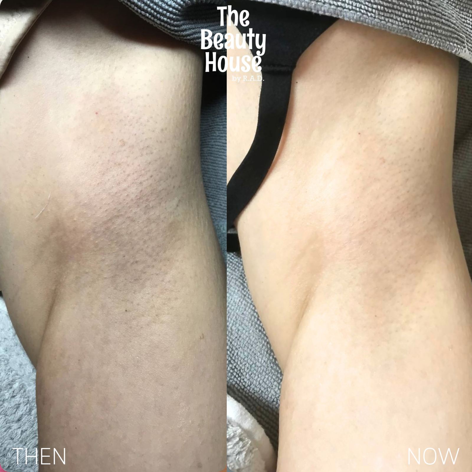 Underarm Laser Whitening
