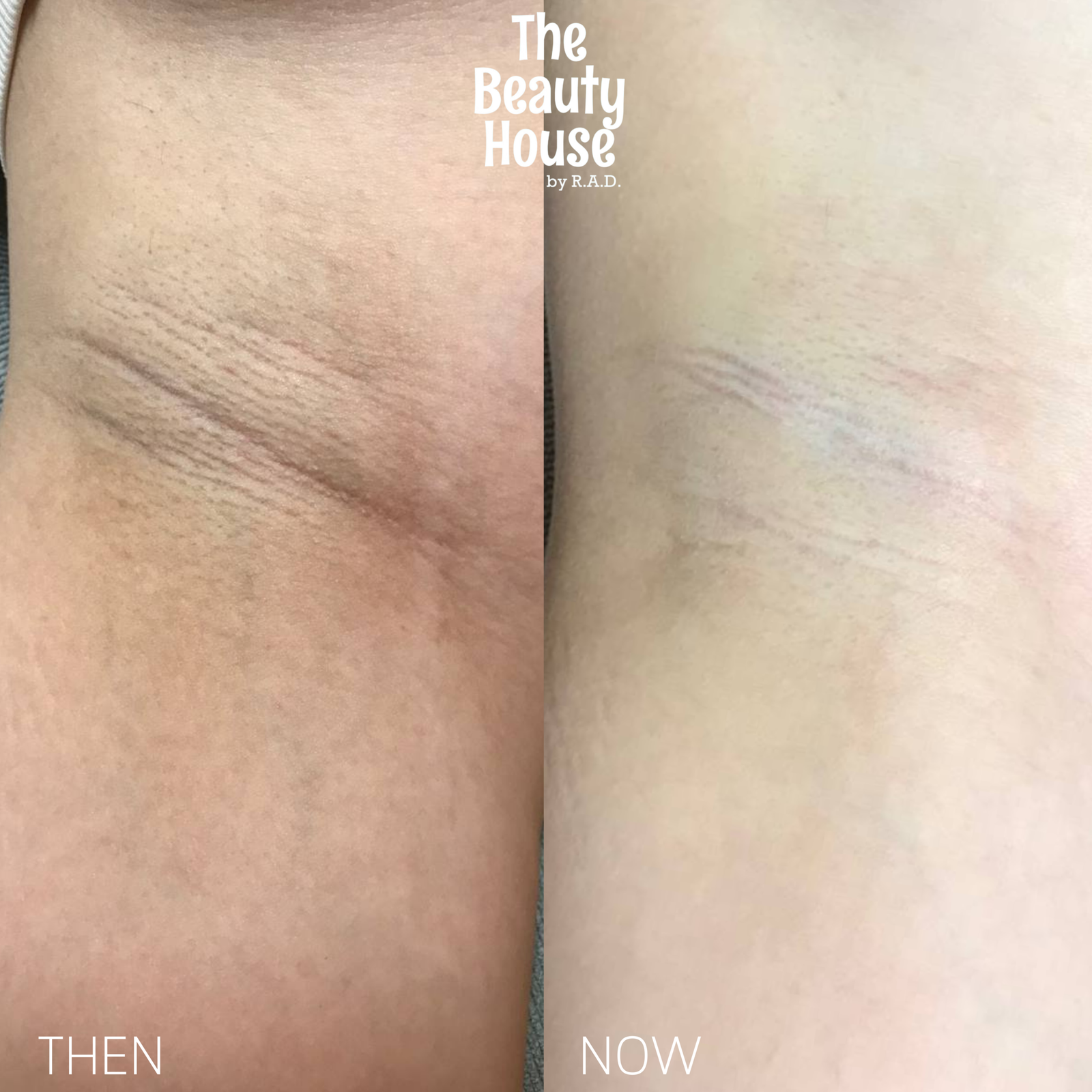 Underarm Rejuvenation