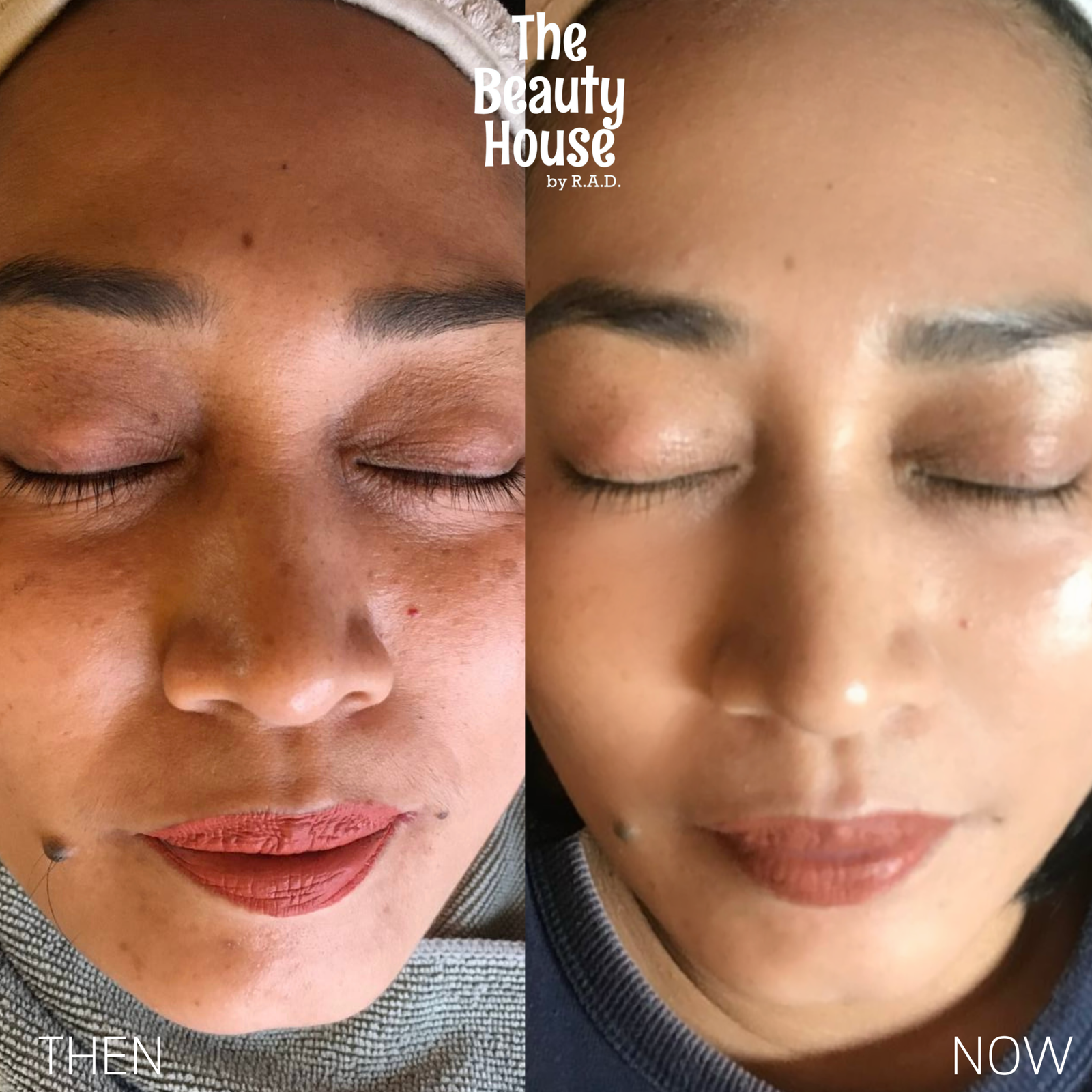 Vita Glow Microinfusion